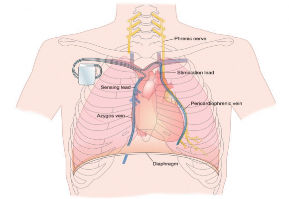 fda-approves-pacemaker-to-treat-central-sleep-apnea-daic