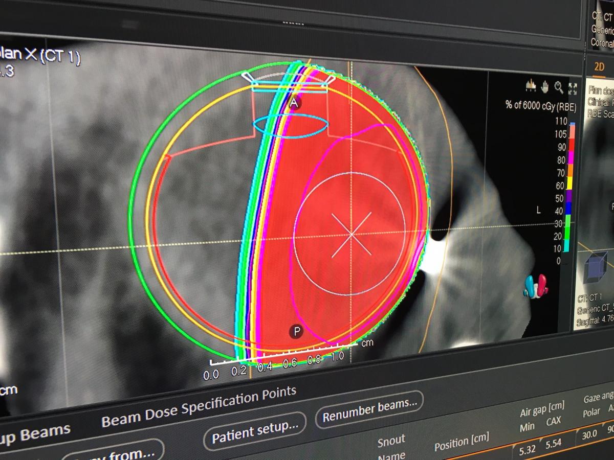 Proton therapy for the eye treatment plan shown by RaySearch at AAPM 2019. #AAPM2019 #AAPM
