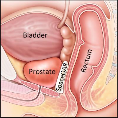 prostate cancer